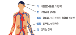 뇌졸증